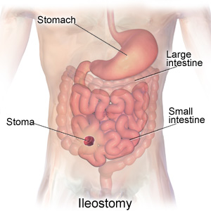 Ileostomy Medical Image Explaining Ileostomy Placement