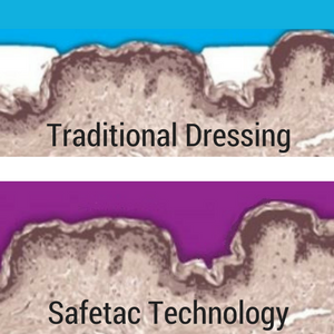 Molnlycke Mepilex Safetac Adhesive Conforming to Wound