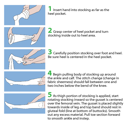 How to Put On T.E.D. Anti-embolism Hose